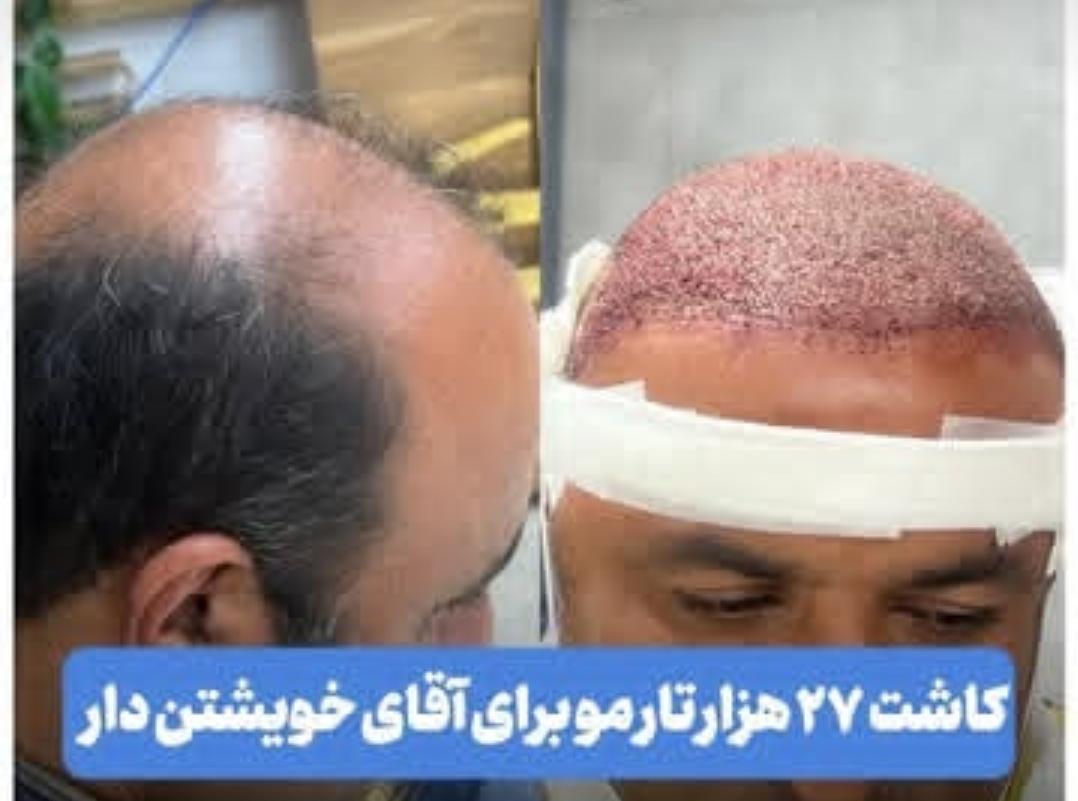 درمان‌های تقویتی مو