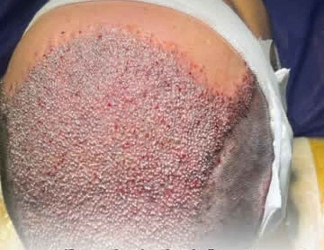 کاشت موی طبیعی